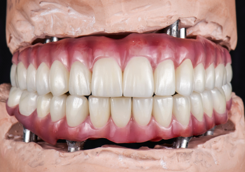 Zubni implantaty_03.png